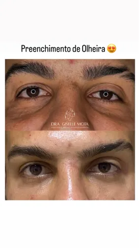 Chega de olhar cansado, preenchimento de olheira já!