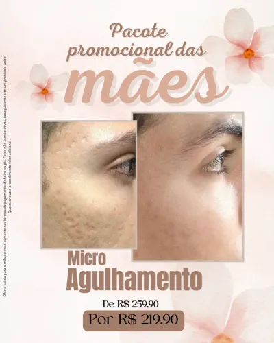 Microagulhamento 