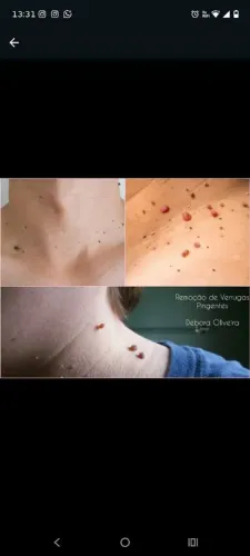 Remoção de pintas e verrugas Pingentes
