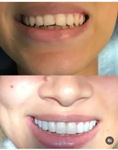 FACETAS DE RESINA