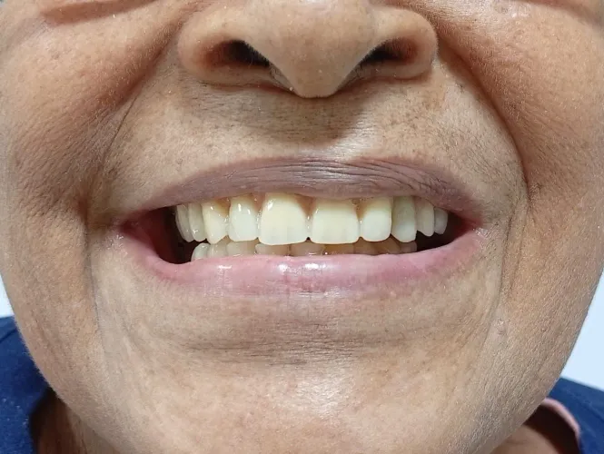 Dentadura