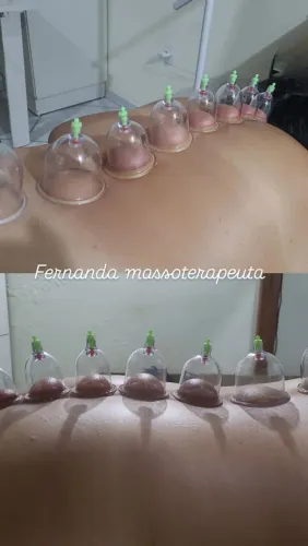 Ventosaterapia 