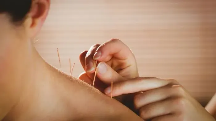 Acupuntura