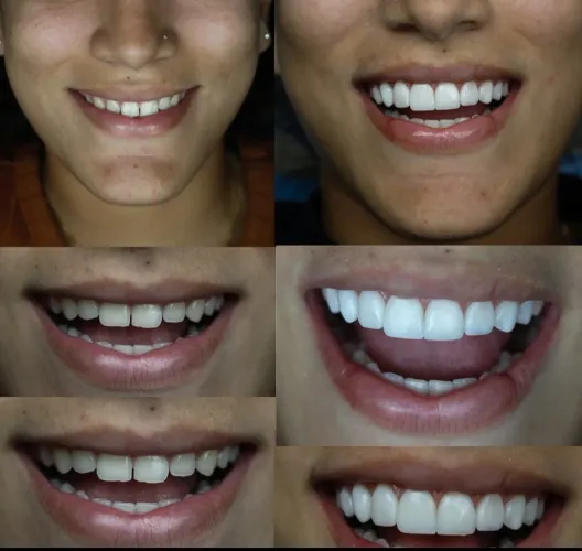 Facetas em RESINA (PROMOÇÃO R$1.999)