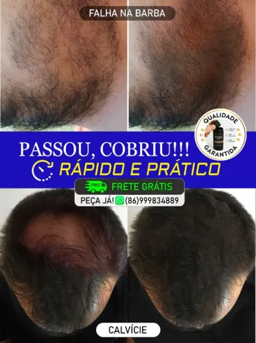 ESCONDE A CALVÍCIE E PREENCHE FALHAS NA BARBA DE FORMA NATURAL!!! ENTREGA GRÁTIS