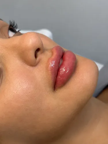 Preenchimento labial / paciente modelo