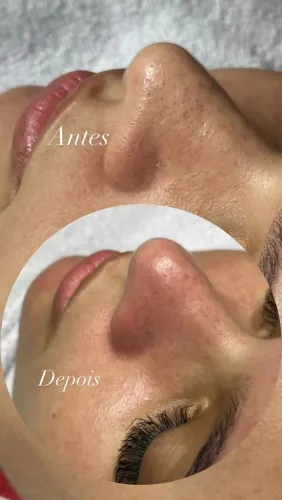 Limpeza de pele