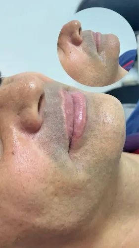 Preenchimento com ácido hialurônico RENNOVA 