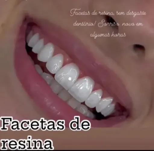 Facetas de resina ou porcelana
