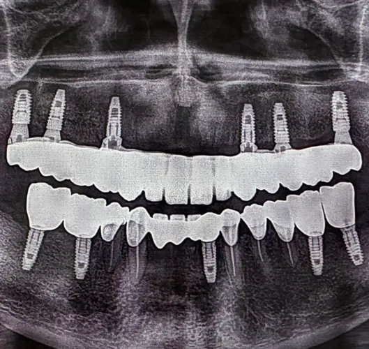Implantes Dentários 