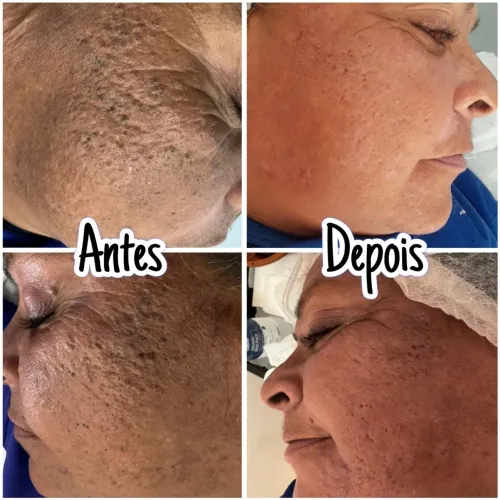 Limpeza de pele promocional