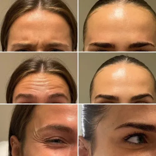 BOTOX