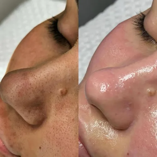 LIMPEZA DE PELE E PROCEDIMENTOS FACIAIS - REALCE SUA BELEZA! Atendimento domiciliar