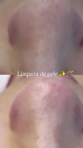 Limpeza de pele profissional 