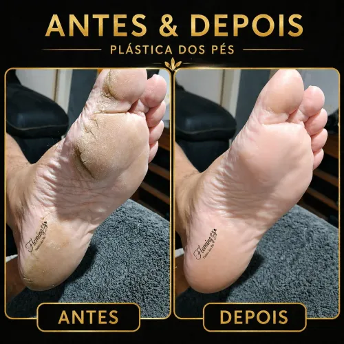 Plastica dos pés 