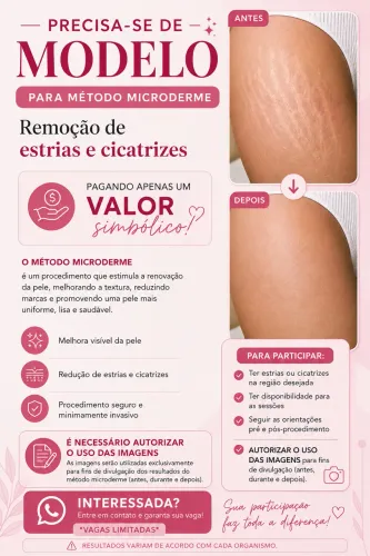 Microderme estrias e cicatrizes