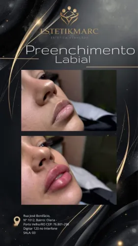 Preenchimento labial