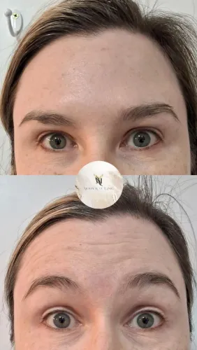 Toxina Botulínica (botox)