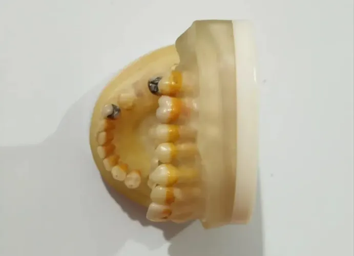 Manequim Periodontia Restauração Pronew