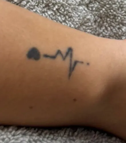 Remoção de Tatuagem R$ 99,00