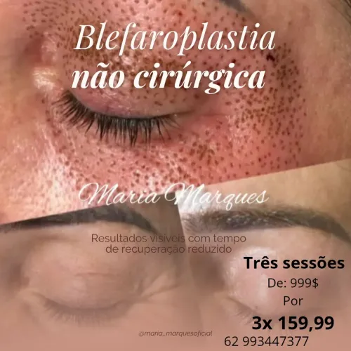 Blefaroplastia
