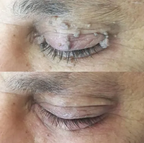 Remoção de Acrocórdons, Verrugas e manchas.