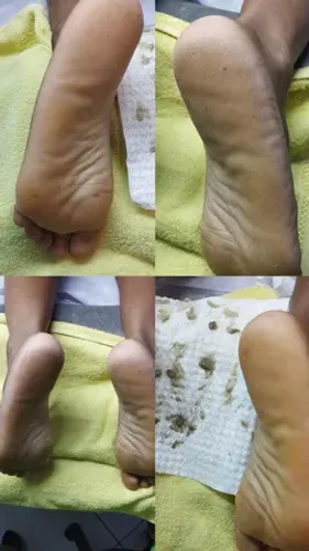 Plástica dos pés 