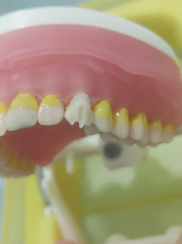 MODELO MANEQUIM DENTISTICA TOP PRO NEW C/ PREPARO INICIADO. VENDA SÓ p/ RECIFE PIX