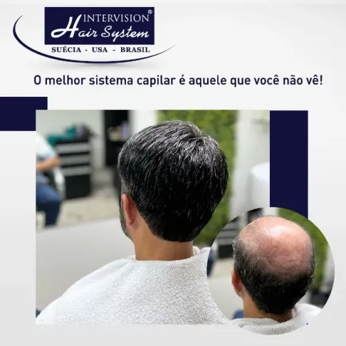 Prótese Capilar Masculina - A Melhor do Brasil!