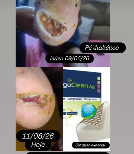 Realização de curativos complexos!