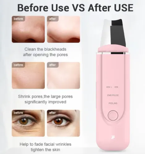 Xiaomi - Peeling Ultrassônico e Ionizador - Tira cravos - Limpeza de Pele - Entregamos