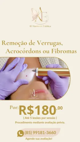 REMOÇÃO DE SINAL