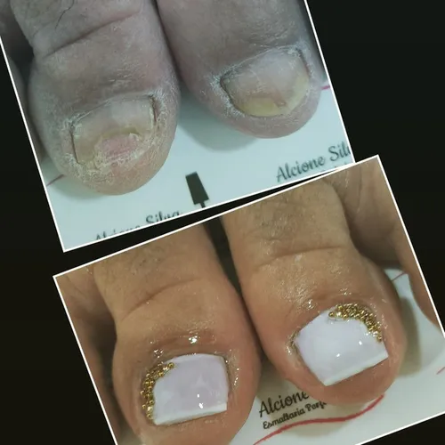 Reconstrução das unhas dos pés