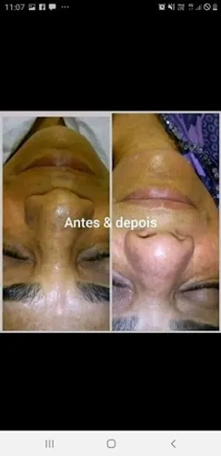 Limpeza de pele 