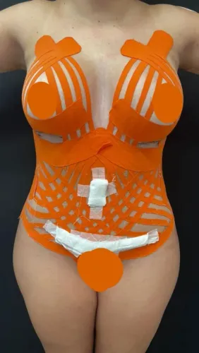 Pós-operatório de Cirurgia Plástica