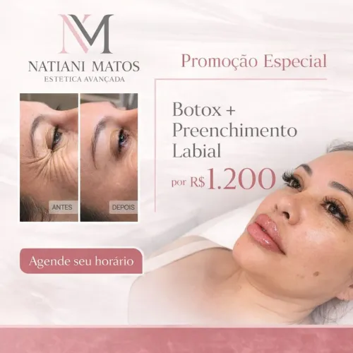 Preenchimento Labial + botox
