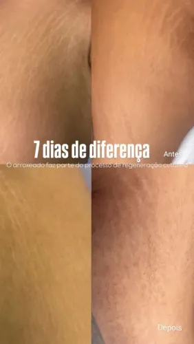 Tratamento estrias