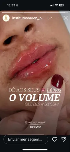 Harmonização facial 