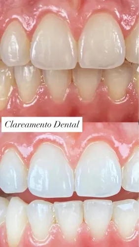 Clareamento dental laser