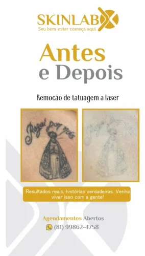 Remoção tatuagem 