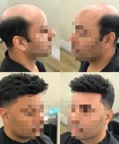 Confecção de prótese capilar,laces e topo laces 