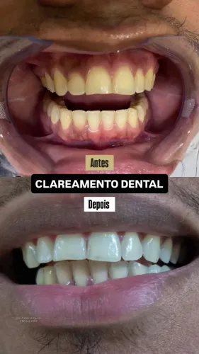 CLAREAMENTO DENTAL EM SÃO LUÍS - MA
