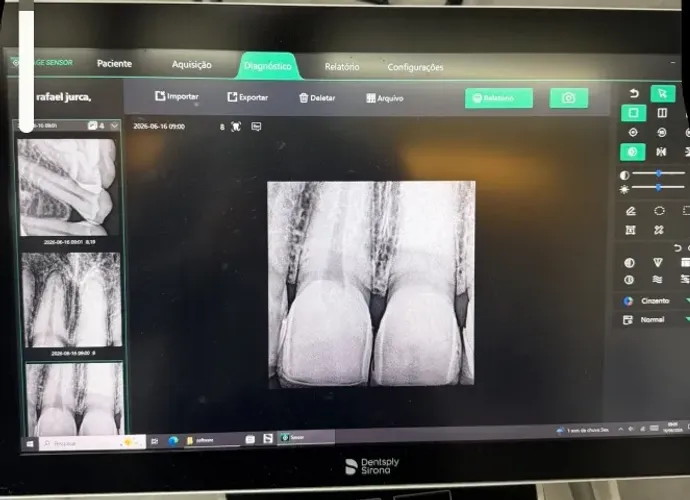 Sensor Rx digital odontologico