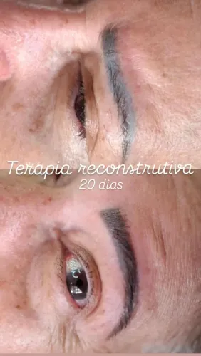 Terapia Reconstrutiva Sobrancelhas 