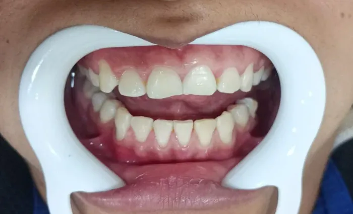 Clareamento dental