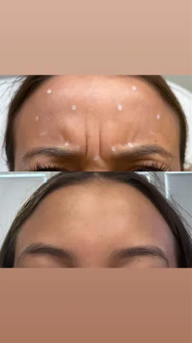 Botox Day?