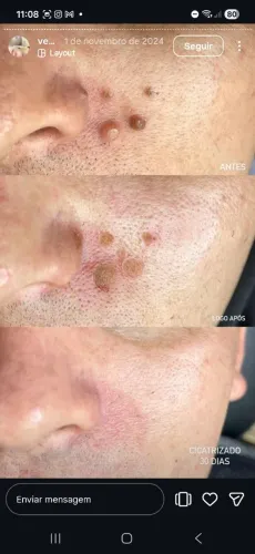 Remoção de sinais