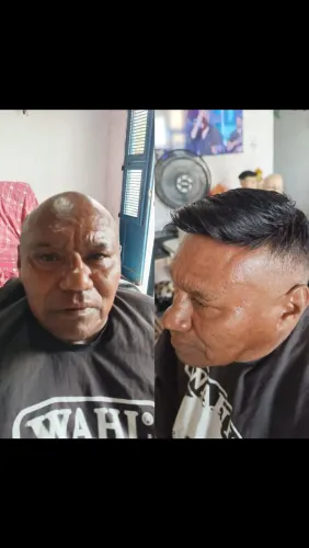 Prótese capilar