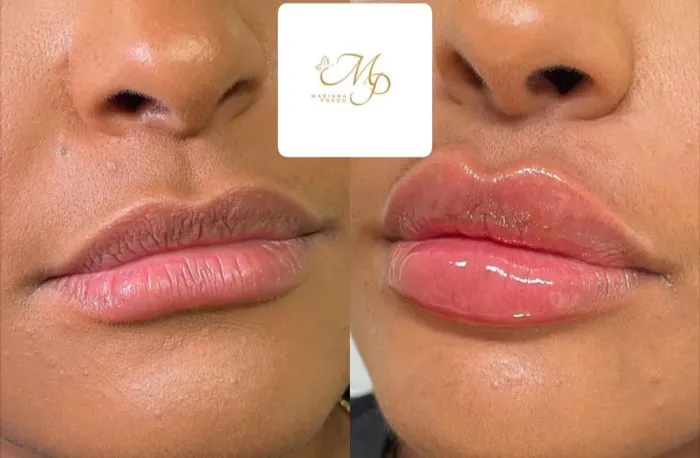 Preenchimento labial e FullFace 