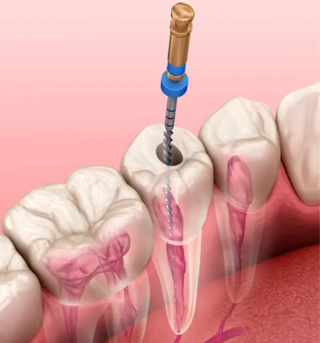 Endodontista